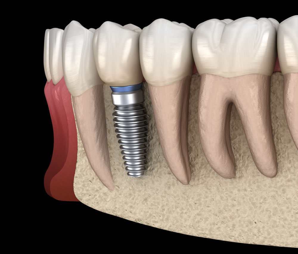 Ce que vous devez savoir sur l’implant dentaire All on 4