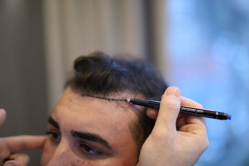 What to Do Before a Hair Transplant in Turkey
