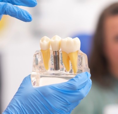 Implantes dentales: qué esperar, procedimiento y precio