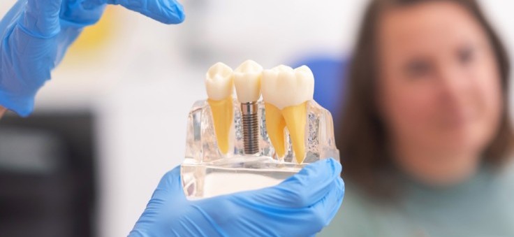 Implantes dentales: qué esperar, procedimiento y precio