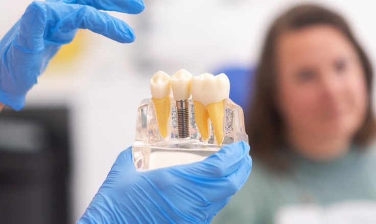 Implantes dentales: qué esperar, procedimiento y precio