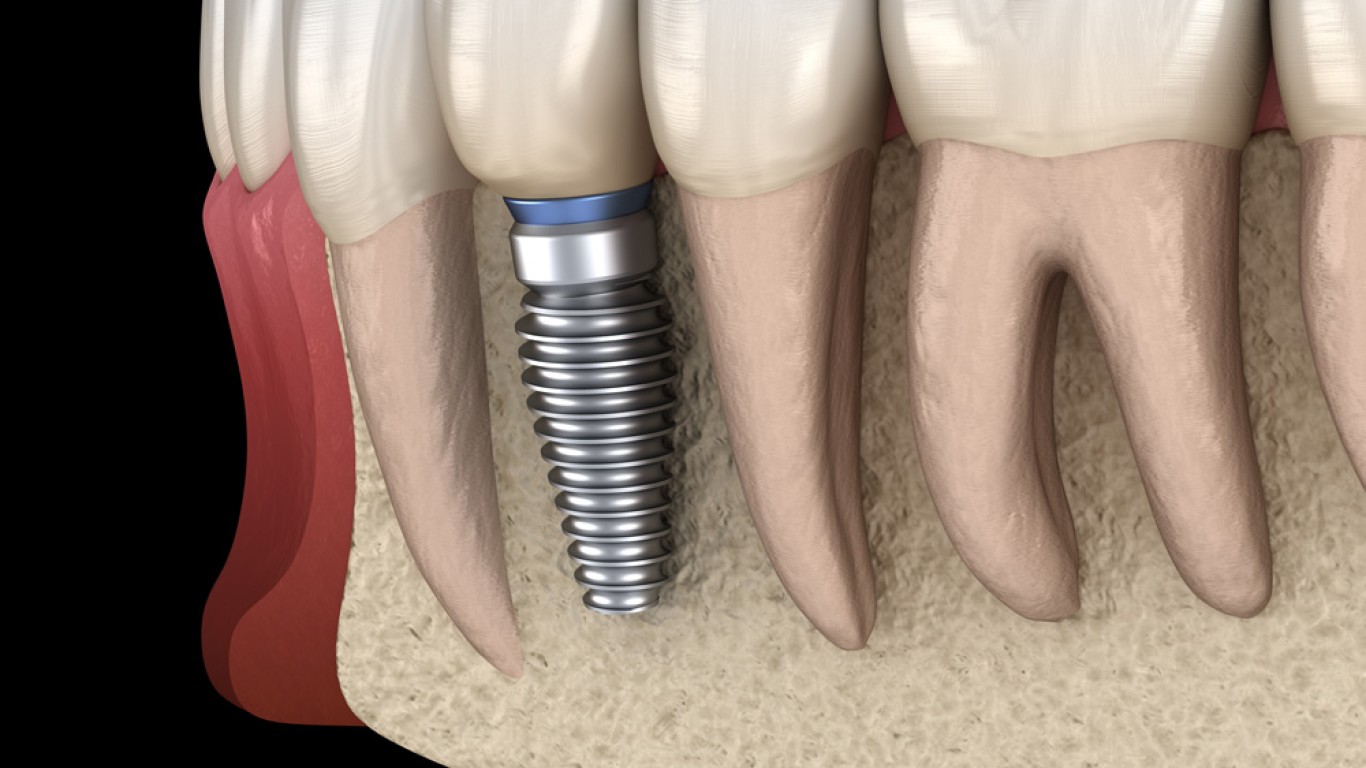 Entiende los beneficios de los All on Six implantes dentales