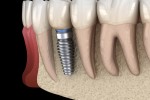Entiende los beneficios de los All on Six implantes dentales