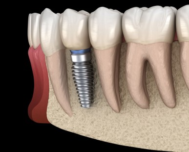 Renueva tu sonrisa: todo sobre los implantes dentales