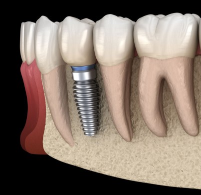 Renueva tu sonrisa: todo sobre los implantes dentales
