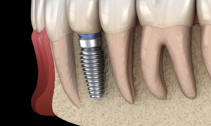 Renueva tu sonrisa: todo sobre los implantes dentales