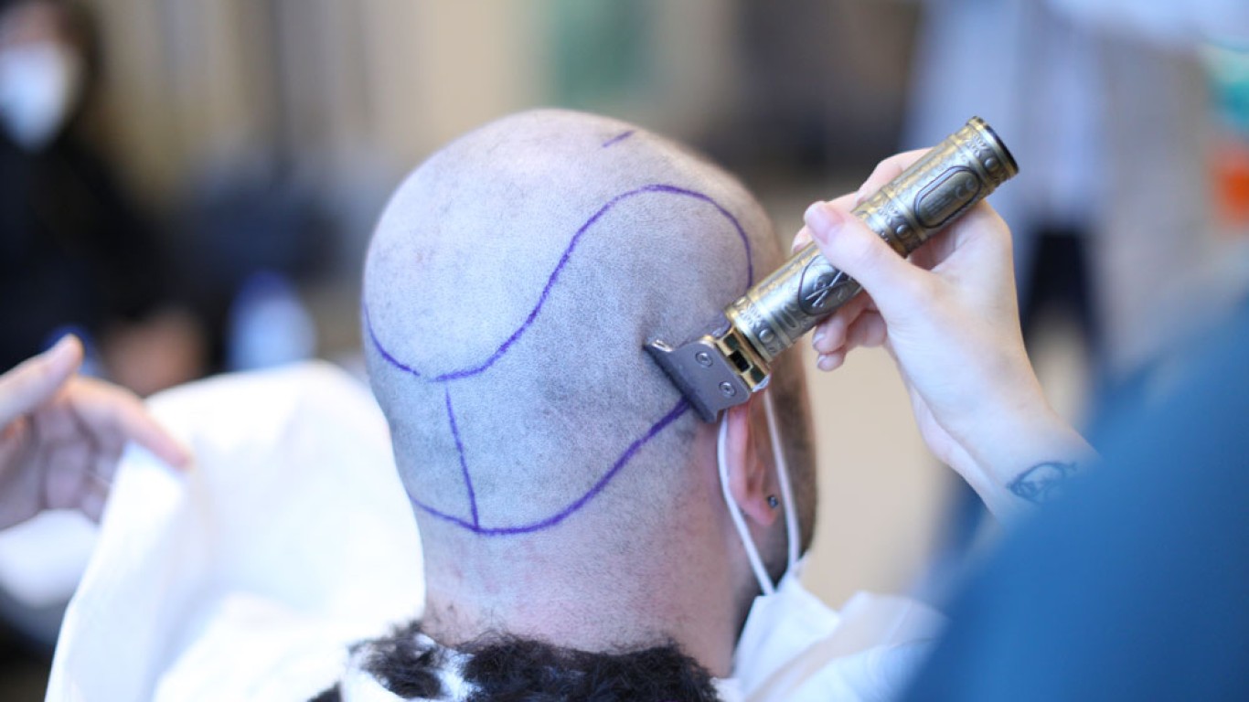 Ventajas y desventajas de los injertos capilares