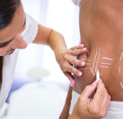 Abdominoplastia o Liposucción: ¿Cuál elegir?