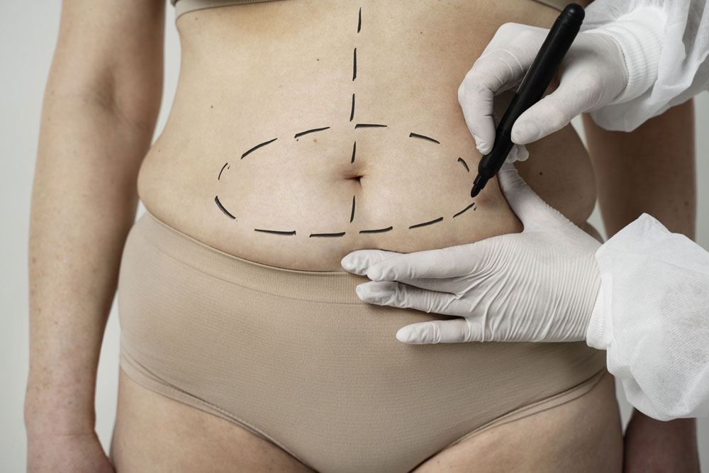 abdominoplastia turquia