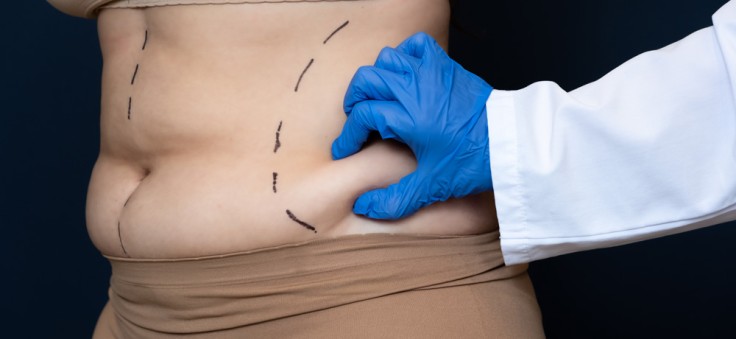 Abdominoplastia: Transformando la estética abdominal 