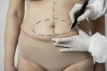 Tout ce qu'il faut savoir sur l'abdominoplastie
