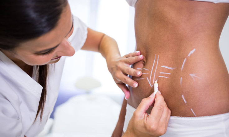 5 Tips for Minimising Scars After an Abdominoplasty