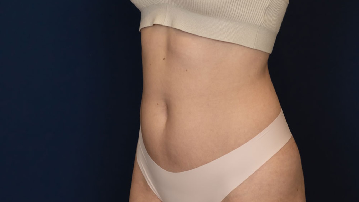 ¿Cómo acelerar la recuperación tras una abdominoplastia?