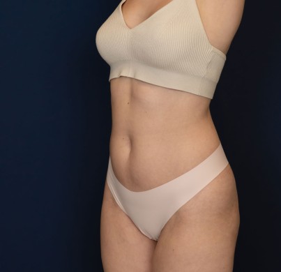 How Can I Speed Up Abdominoplasty Recovery?