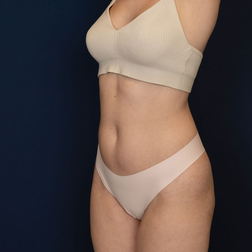 Abdominoplastia