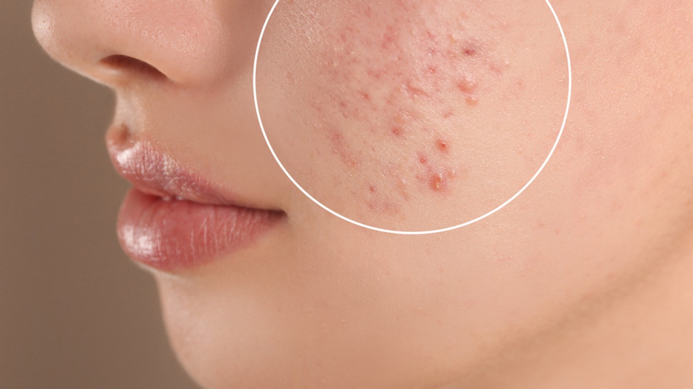 Acne Scar Treatment in Turkey: What Works Best in 2026