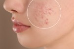 Acne Scar Treatment in Turkey: What Works Best in 2026