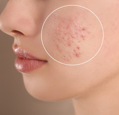 Acne Scar Treatment in Turkey: What Works Best in 2026