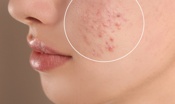 Acne Scar Treatment in Turkey: What Works Best in 2026