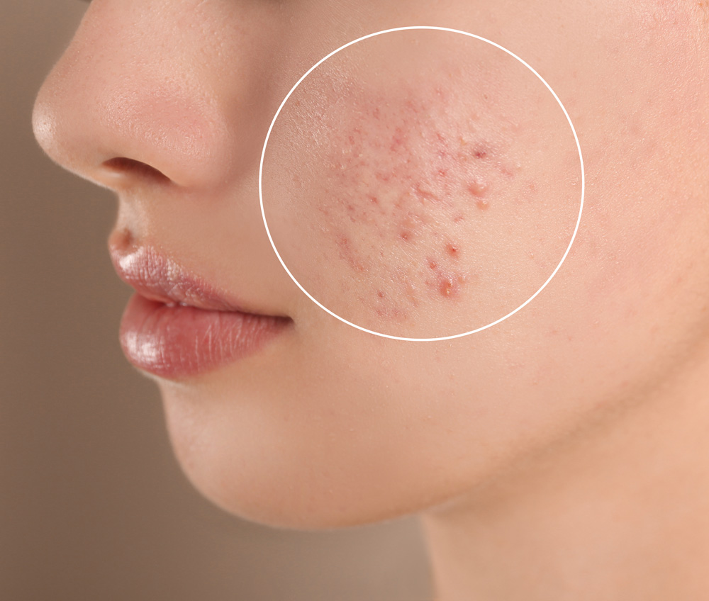 What is an Epidermoid Cyst: Diagnosis, Treatment, and Recovery