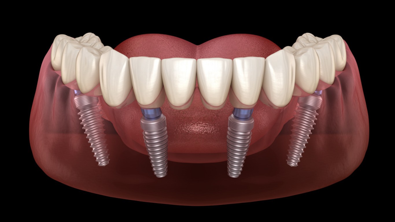 What You Need To Know About All on 4 Dental Implants