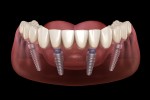 Ce que vous devez savoir sur l’implant dentaire All on 4