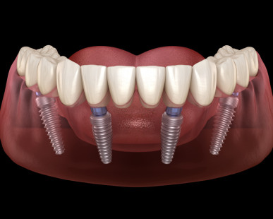 What You Need To Know About All on 4 Dental Implants