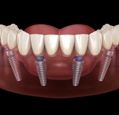 Ce que vous devez savoir sur l’implant dentaire All on 4