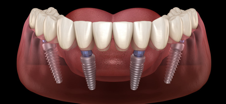 Ce que vous devez savoir sur l’implant dentaire All on 4