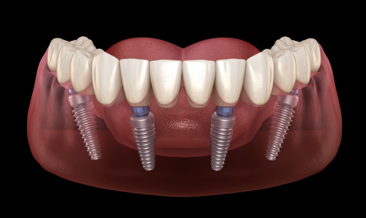 Ce que vous devez savoir sur l’implant dentaire All on 4