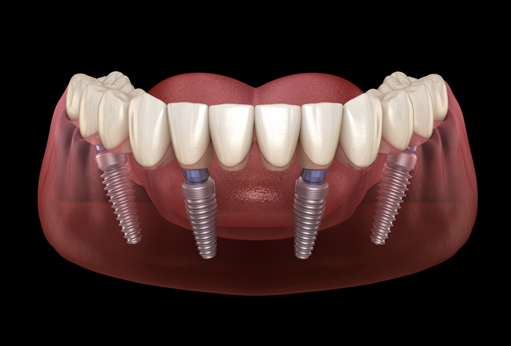 What You Need To Know About All on 4 Dental Implants