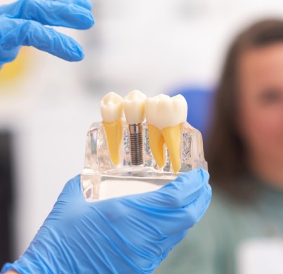 Qué esperar durante la recuperación de implantes dentales All-on-6