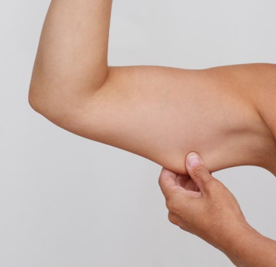 Que se passe-t-il après votre lifting des bras (brachioplastie) ?