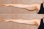 Brachioplasty in Turkey: Benefits, Procedure and Cost