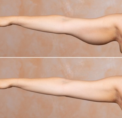 Brachioplasty in Turkey: Benefits, Procedure and Cost