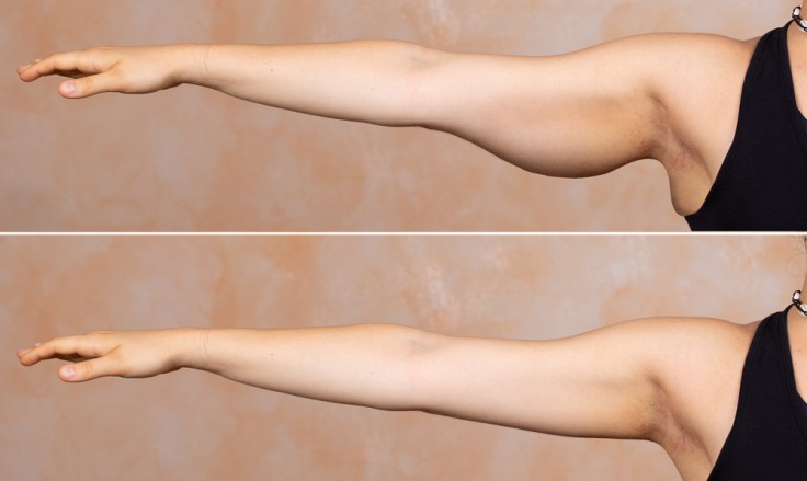 Brachioplasty in Turkey: Benefits, Procedure and Cost