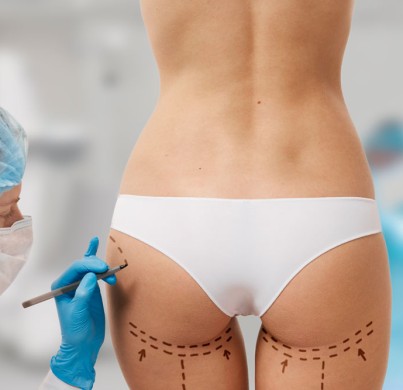 How a Spiral Thigh Lift Improves Inner and Outer Thighs