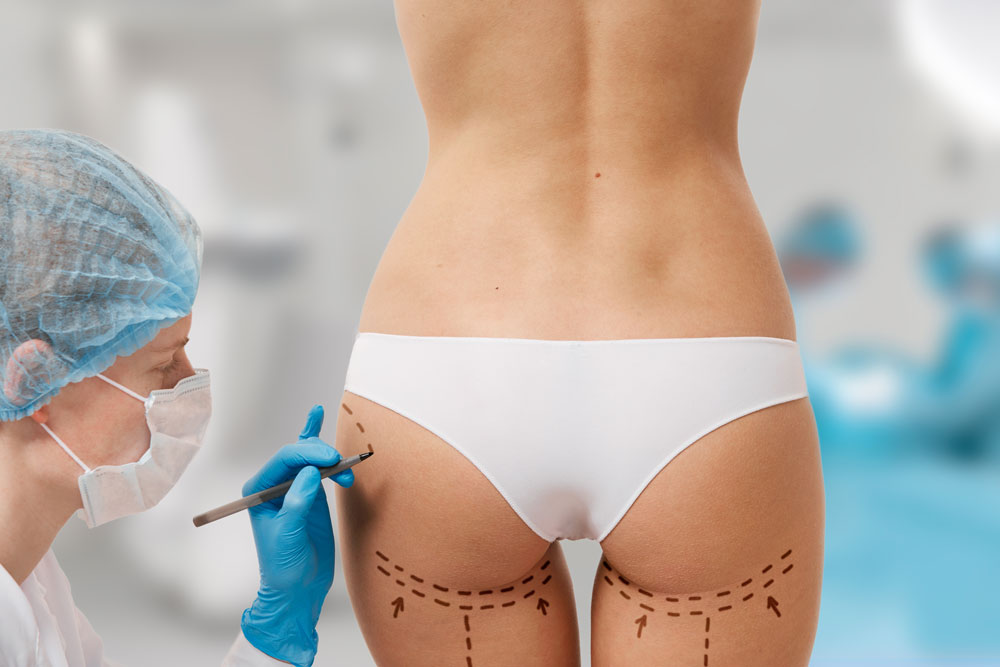 Brazilian Butt Lift (BBL) türkei