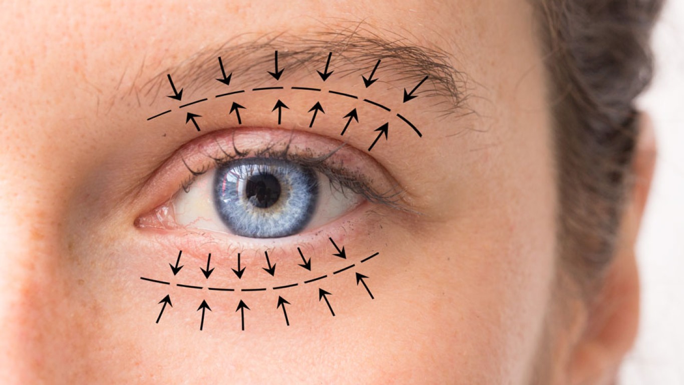 L’essentiel à savoir sur la récupération après une blépharoplastie