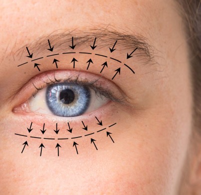 5 conseils pour une récupération rapide après une blépharoplastie