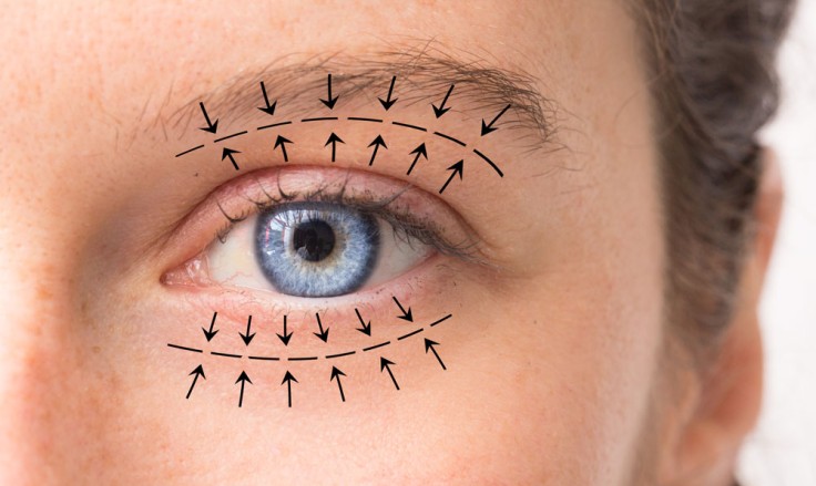 Everything You Need to Know About Blepharoplasty