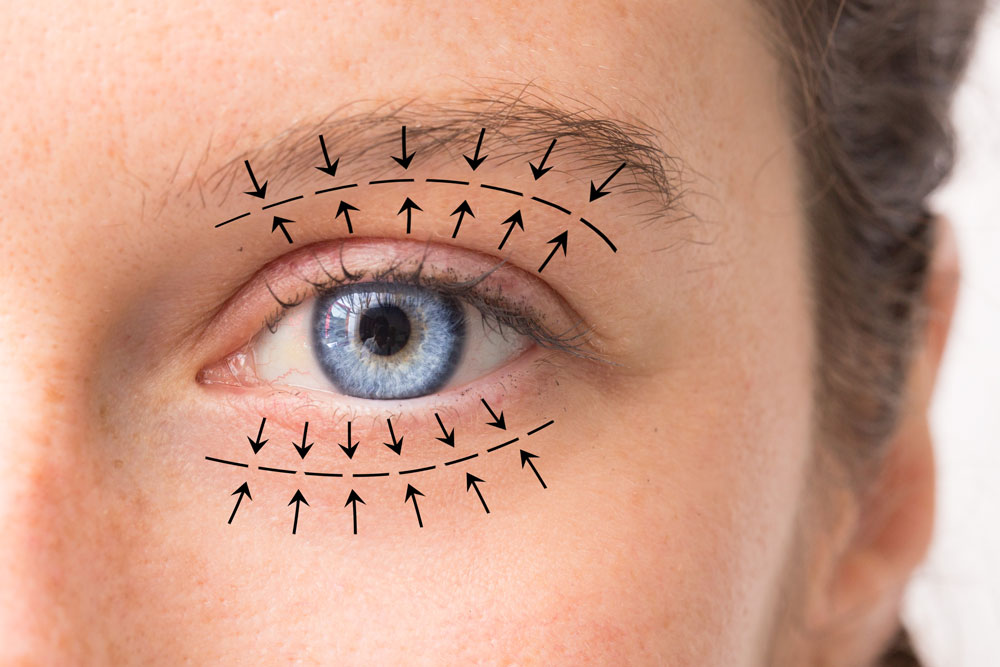 Everything You Need to Know About Blepharoplasty