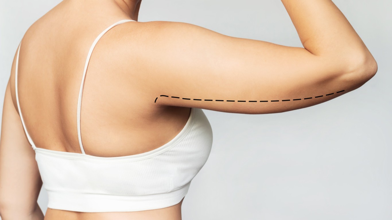 Brachioplasty in Istanbul: Benefits, Procedure, and Recovery