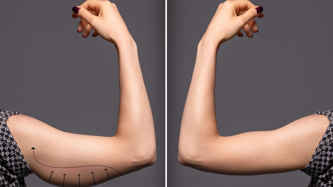 7 choses à savoir sur la brachioplastie