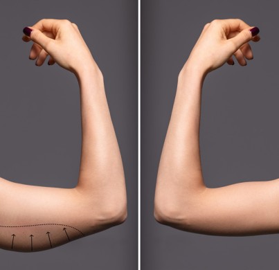 7 cosas que debes saber sobre la braquioplastia