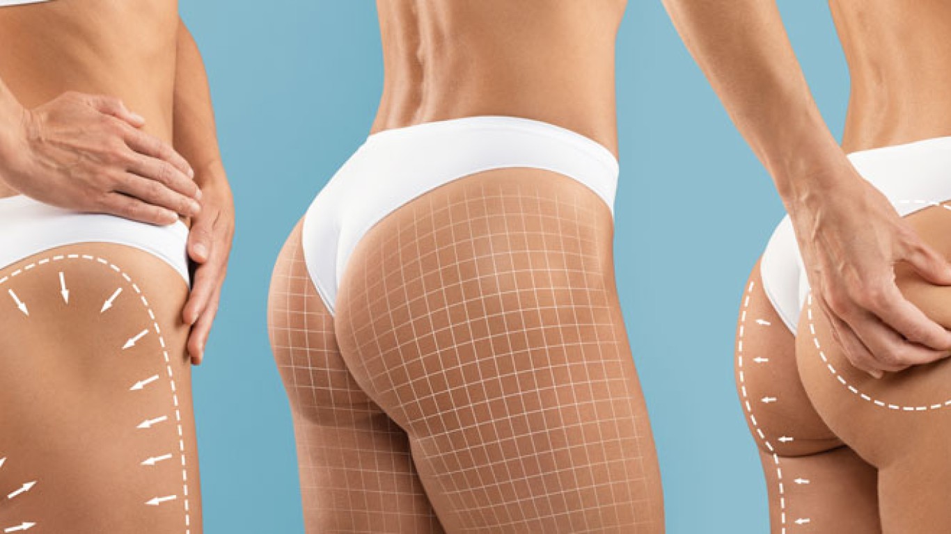 Was Sie nach einem Brazilian Butt Lift (BBL) in der Türkei erwartet