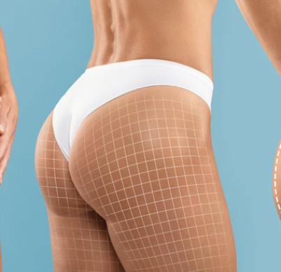 What to Expect After a Brazilian Butt Lift in Turkey