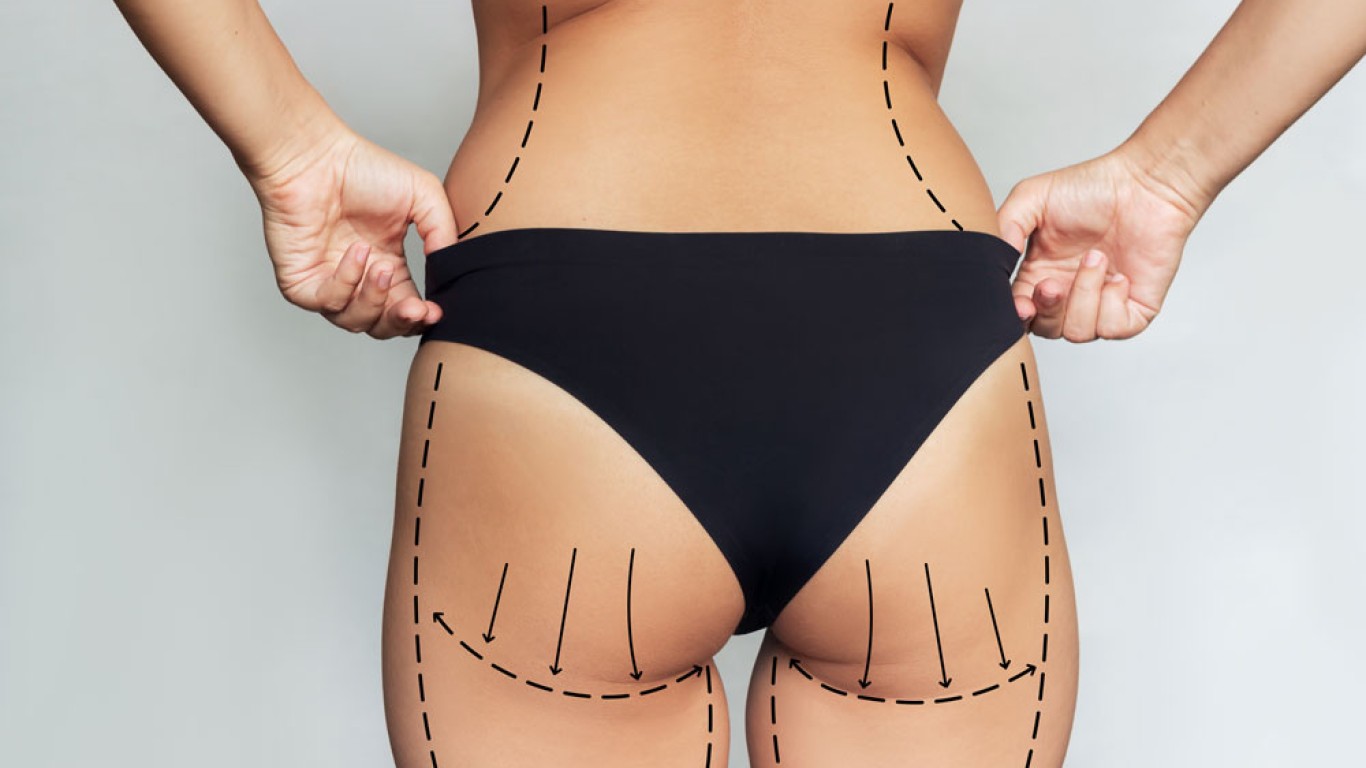 5 Things You Need to Know About Recovery After a Brazilian Butt Lift (BBL)