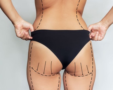 Wie Radiofrequenz Cellulite wirksam reduziert