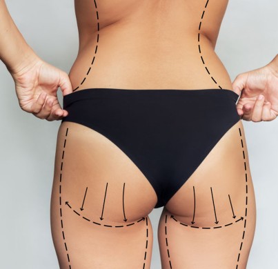 What Affects the Final Thigh Lift Cost